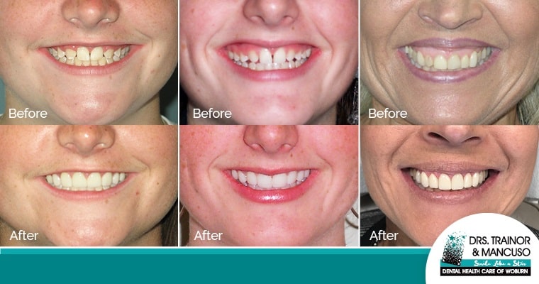 Porcelain veneers before and after in Woburn, MA