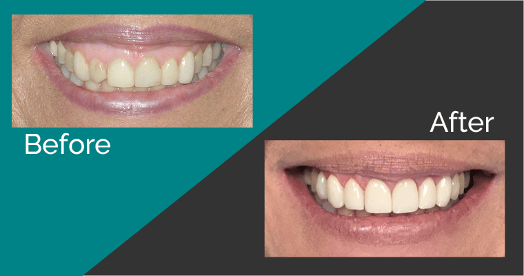 Close up of a patient's smile before and after dental treatment